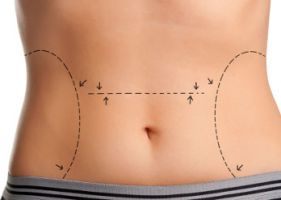 abdominoplastik kliniken nuremberg Praxis Dr. Sebastian